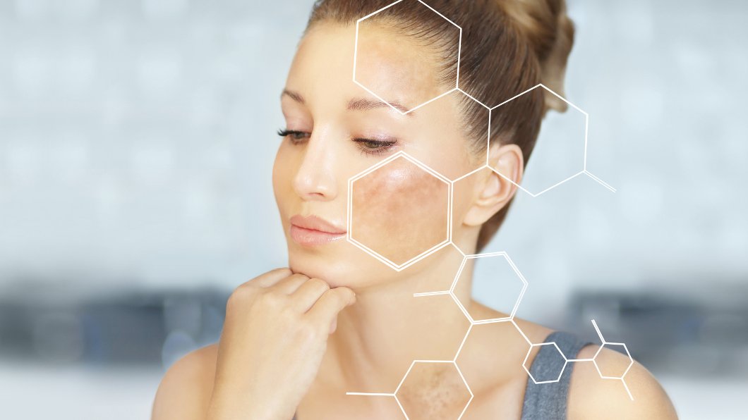 How to deal with rosacea and hyperpigmentation